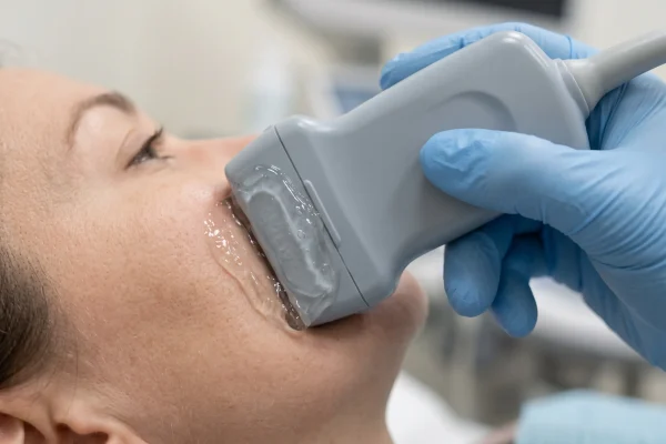 Sofwave ultrasound handpiece delivering heat to the mid-dermis on the cheek