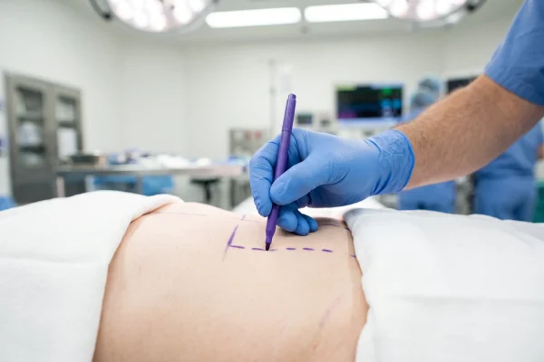 Surgeon marking incision lines before a full versus mini tummy tuck procedure