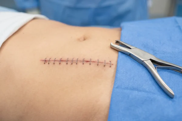 Surgical staples along a healing lower abdominal incision before removal