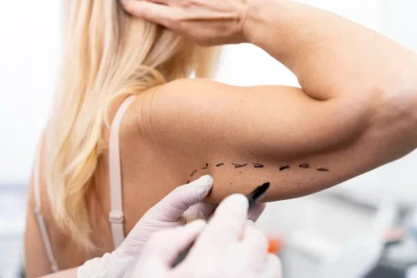 Woman getting plastic surgery reversal after failed lipo