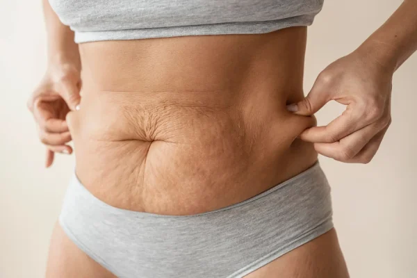 Woman in grey colored underwear pinching excess skin before tummy tuck procedure