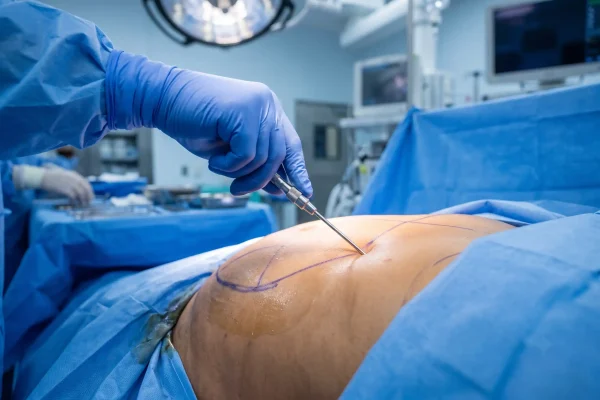Close-up of abdominal etching technique during HD liposuction