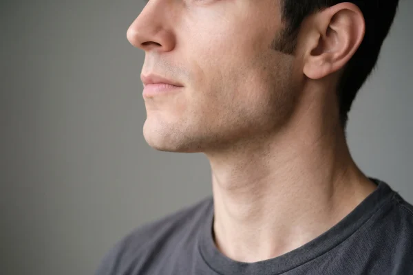 Defined jawline after non-surgical injectable contouring