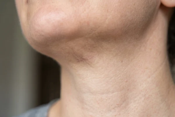 Healed micro-incision showing minimal scarring after neck lipo procedure