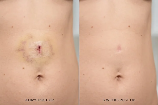 Liposuction incision healing progression from light bruising to faded scar