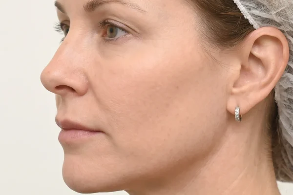 Patient after getting a chin tightening treatment