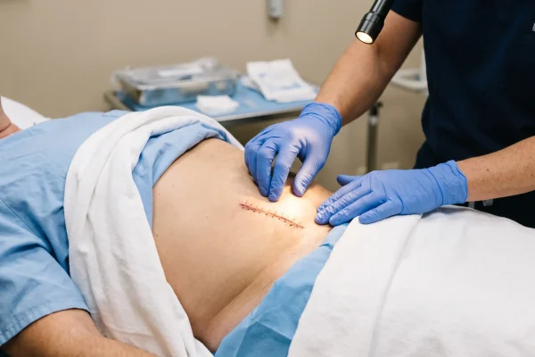 Provider checking a tummy tuck incision for redness and drainage at a post op visit