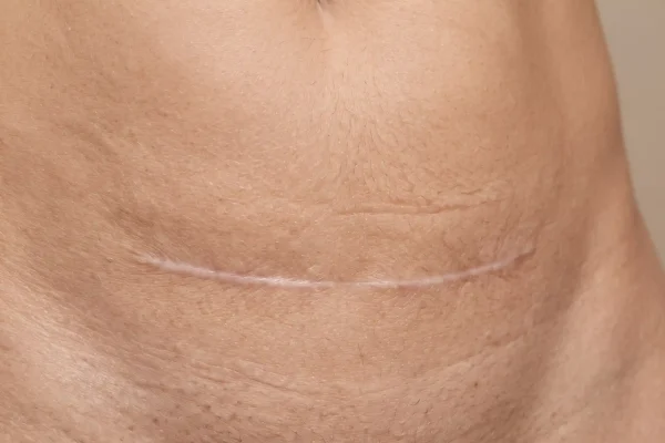 Well healed flat tummy tuck scar low on the abdomen at twelve months