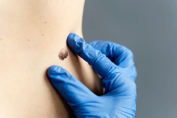 Doctor with blue gloves examining skin growth on patient's back as part of keloid prevention assessment.