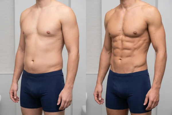 Before and after comparison of high def lipo versus regular lipo
