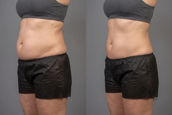 Before and after midsection contour showing who liposuction suits