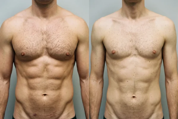 Body composition comparison for ideal HD liposuction candidates for male abs