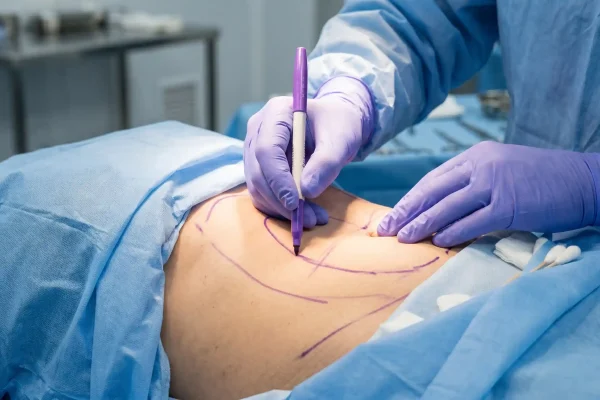 Surgeon marking abdominal areas for body contouring after GLP-1 weight loss