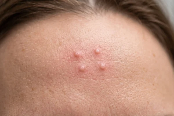 Photorealistic macro of subtle small raised bumps on a smooth adult forehead just after injection, slight redness, even soft lighting, realistic pores, neutral tone.