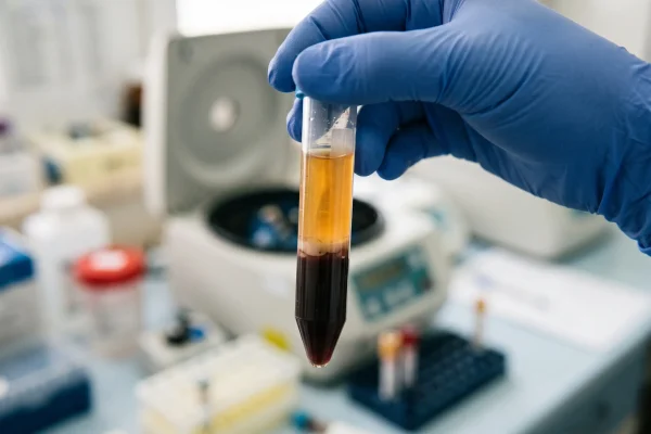 Centrifuge tube showing the platelet layer used in PRP injections
