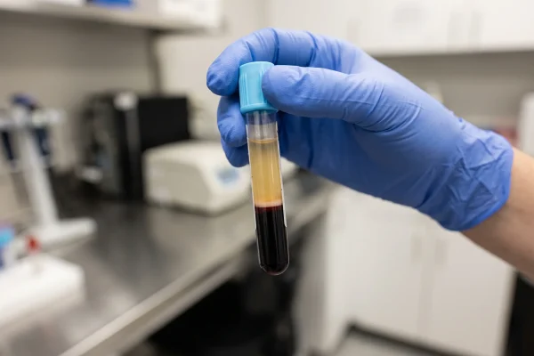 Centrifuged tube showing the buffy coat layer used for PRP hair treatment