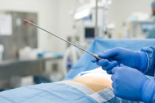 Surgeon holding cannula used during chin liposuction procedure