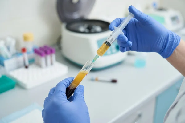 Clinician drawing concentrated PRP into syringe for hair restoration
