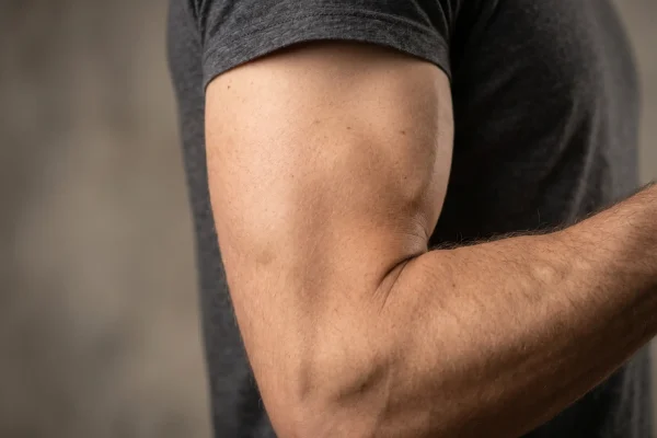 Close-up of a defined upper arm after permanent arm lipo fat removal