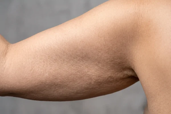 Close-up of crepe skin texture on the back of the upper arm from elastin loss