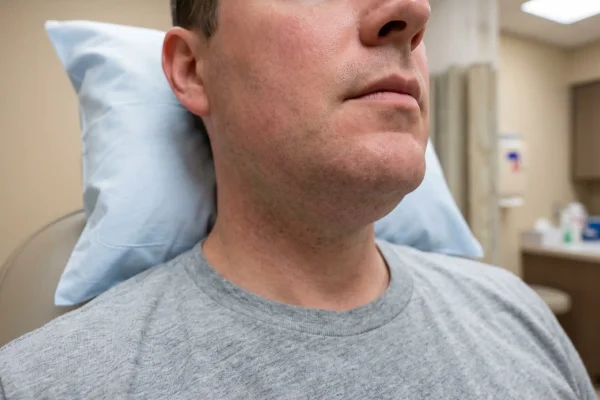Close-up of mild swelling along the jaw after a PDO thread lift