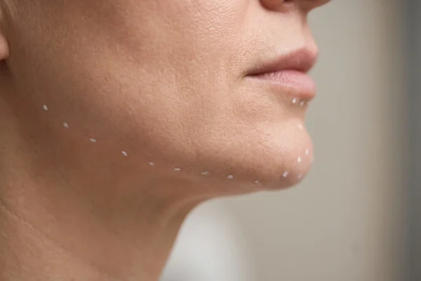 Close-up of the mandible and chin marked as jawline filler placement zones