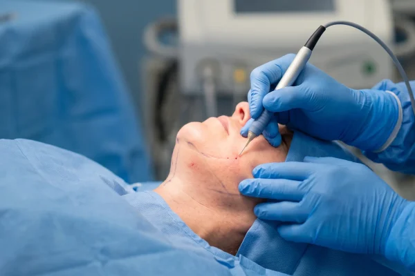 FaceTite radiofrequency probe used under the skin along the jawline