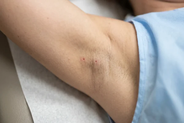 Faint injection marks after armpit Botox showing mild, temporary side effects