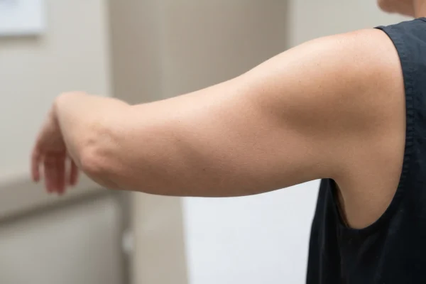 Firm smooth arm skin showing skin tightening after arm lipo