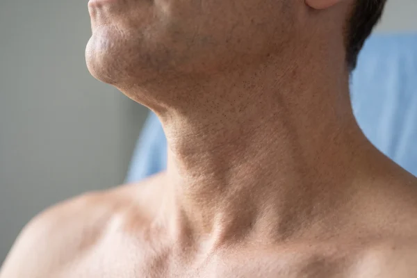 Four contributors to neck shape beyond fat: muscle, skin, chin projection