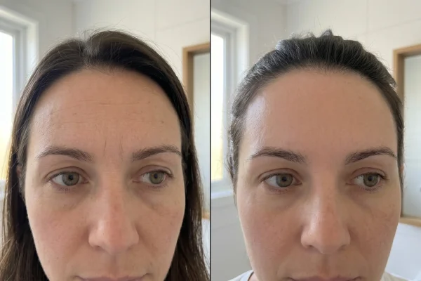 Full Botox results visible around day 10 to 14 after treatment