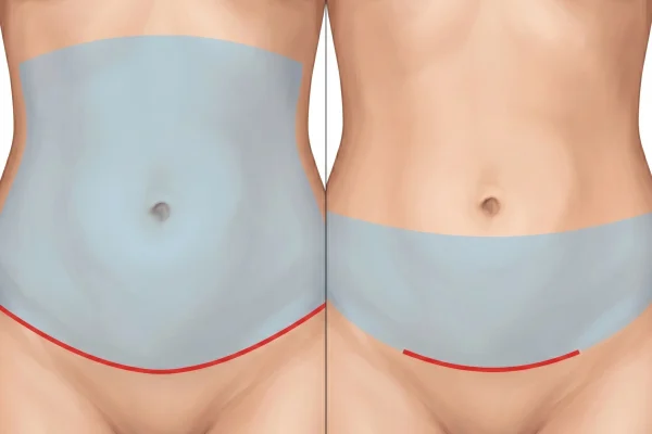 Full versus mini abdominoplasty incision comparison infographic