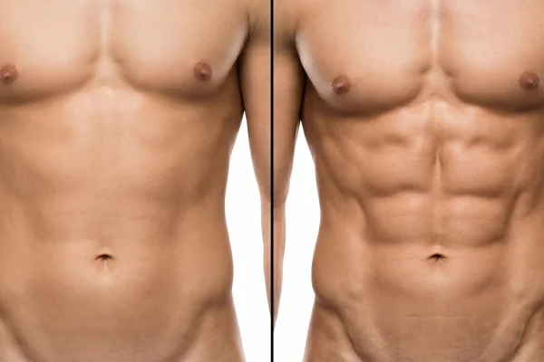 HD lipo vs traditional liposuction abdominal results comparison