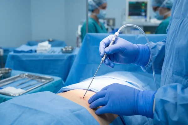 hd liposuction cannula technique