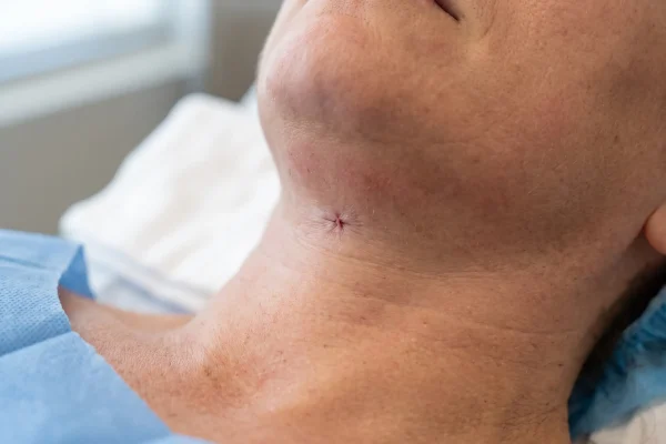 Healing submental incision after neck liposuction with no infection signs
