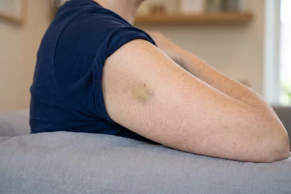 Minor bruising, a common arm Botox side effect