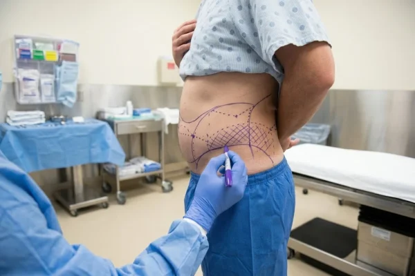 Surgeon marking abdomen and flanks before multi zone HD liposuction planning