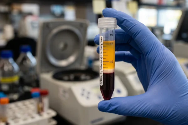Separated platelet-rich plasma layer used for PRP hair treatment