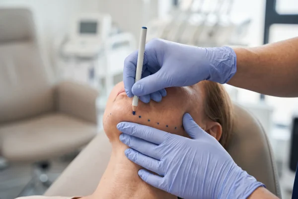 Provider marking the jawline before placing new PDO threads over old ones