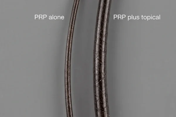 Strand caliber comparison showing PRP hair thickness gains with combination therapy