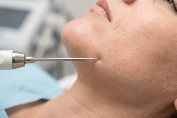 Subdermal radiofrequency probe used in FaceTite and Renuvion skin tightening