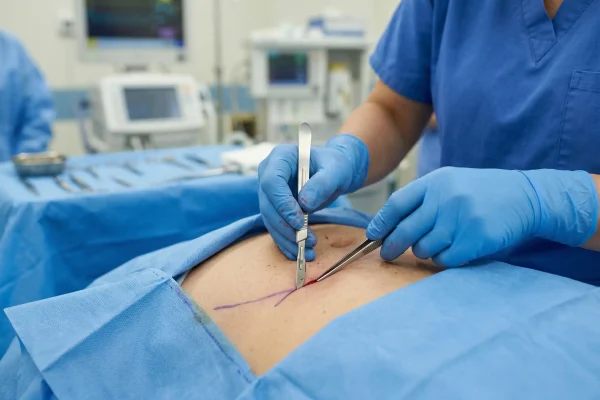 surgeon doing abdominoplasty procedure
