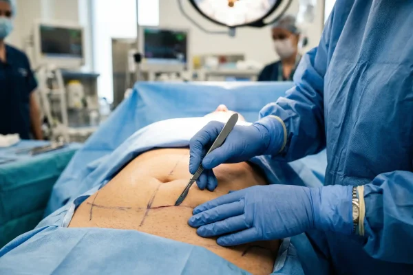 surgeon doing tummy tuck procedure