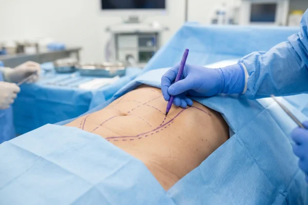 Surgeon marking the chin area before neck liposuction