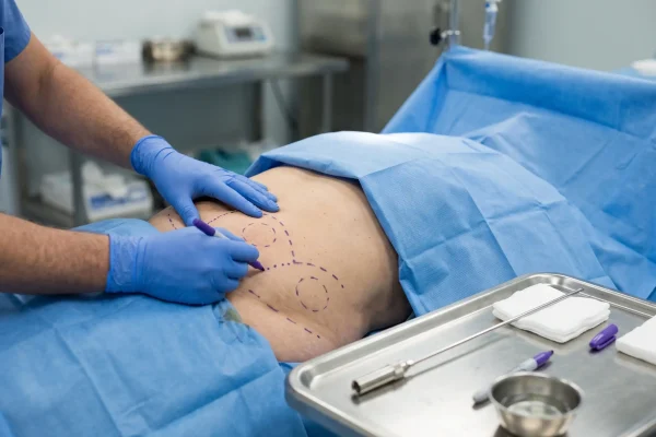 Surgeon marking an abdomen before regular liposuction fat removal