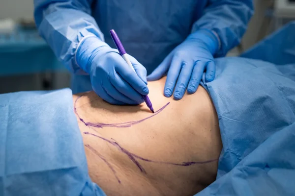 Surgeon marking contour planning lines on an abdomen before liposuction in Tampa