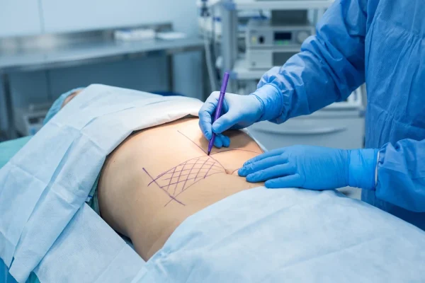 Surgeon marking contours before liposuction, where technique affects pain