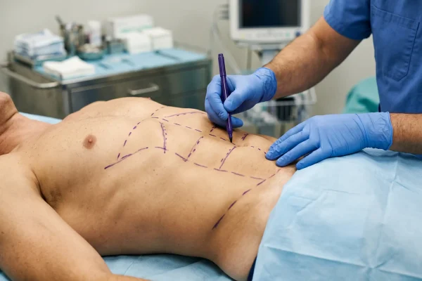 Surgeon marking HD liposuction etching lines on a lean male abdomen