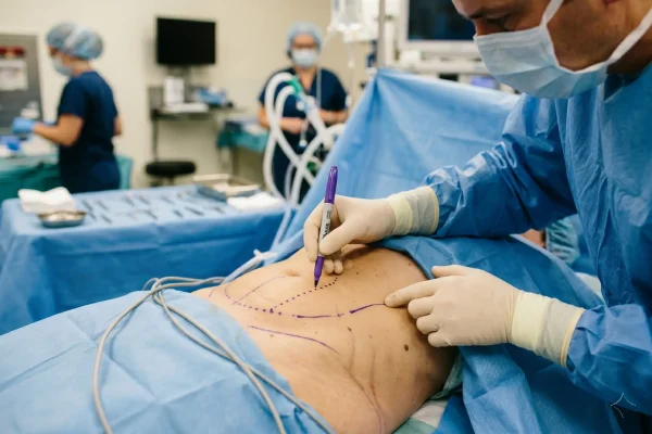 Surgeon marking incision lines before tummy tuck procedure