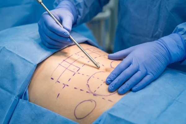 Surgeon with cannula and markings showing how liposuction works step by step